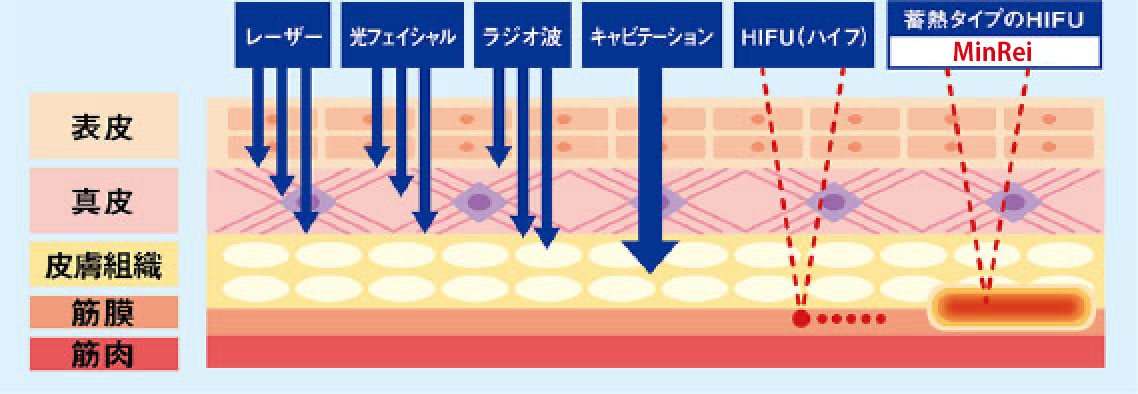 MinReiは卒業まで最短3ヶ月!